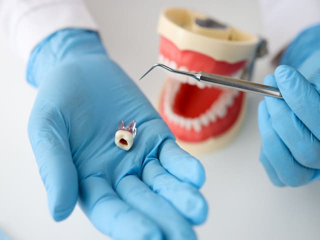 cuánto cuesta un implante dental